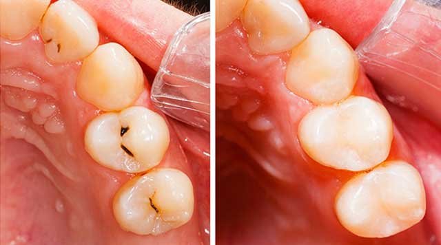 Soins Dentaires Conservateurs